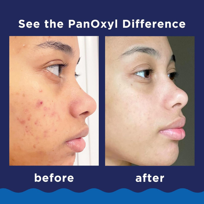 PanOxyl Acne Foaming Wash Maximum Strength 10% Benzoyl Peroxide Cleanser for Face, Chest & Back Acne, 5.5oz